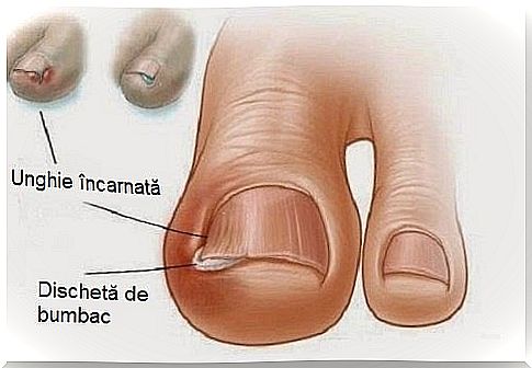 6 natural remedies for ingrown nails