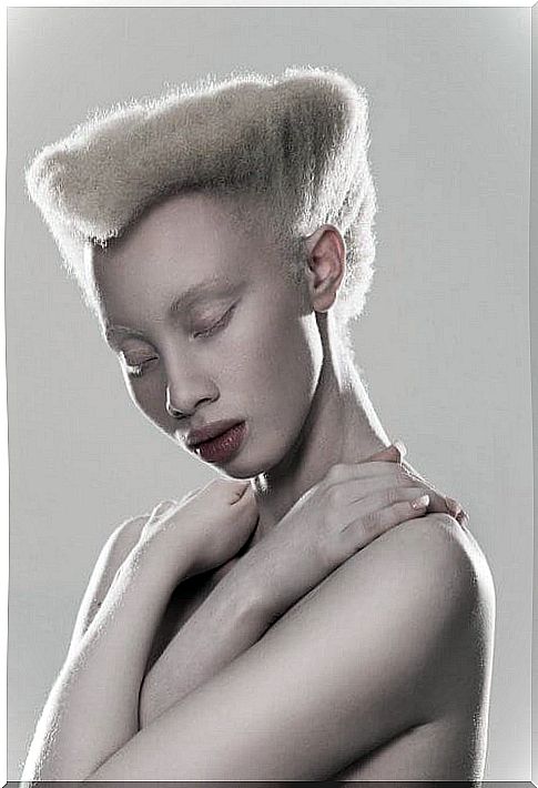 Albinism affects a model