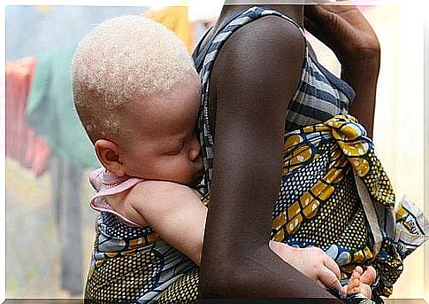 Albinism in a sick child