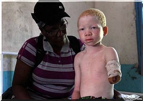 Albinism in a mutilated child