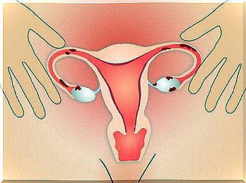 Blood clots caused by endometriosis