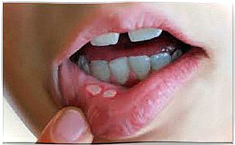 Canker sores: natural causes and remedies