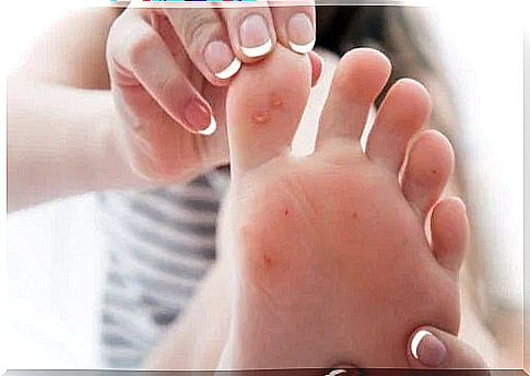 Causes of the appearance and treatment of calluses