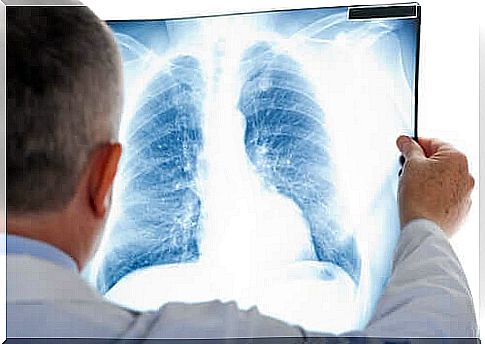 Doctor studying a chest x-ray