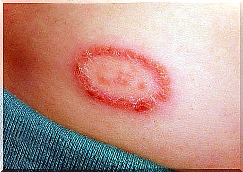 Circumcised herpes causes rashes