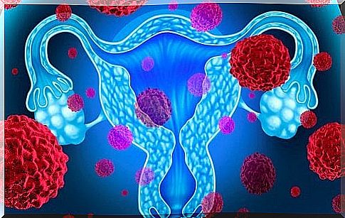 Endometrial cancer: 5 important facts