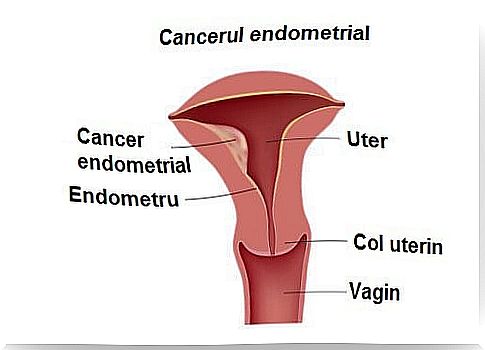 Endometrial cancer in women