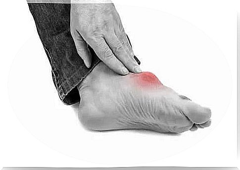 Foot affected by gout