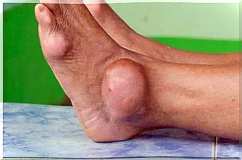 Information on purine that causes gout