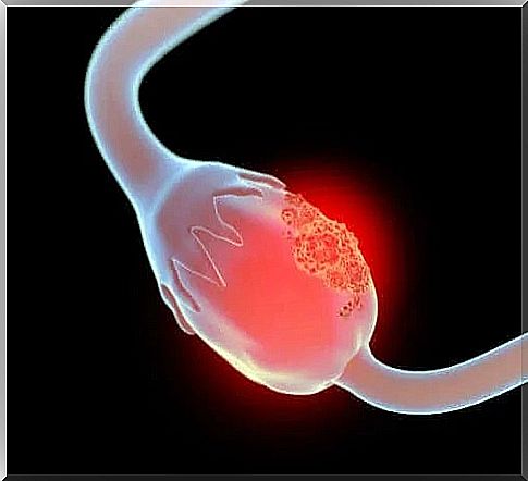 Giant mucinous cystadenoma of the ovary