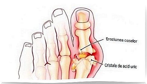 Gout is triggered when the level of uric acid in the body is excessive