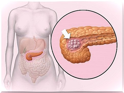 Pancreatic cancer in women