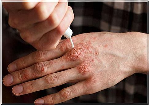 Moisturizing remedy for psoriatic arthritis