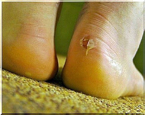 Liquid blisters - 5 natural remedies