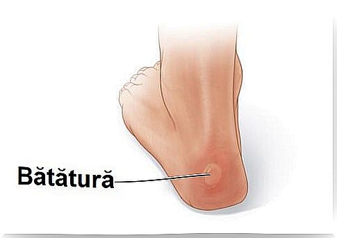 Fluid blisters affecting a man's heel