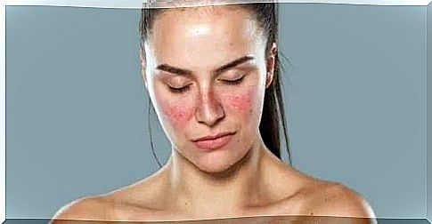 Woman with lupus