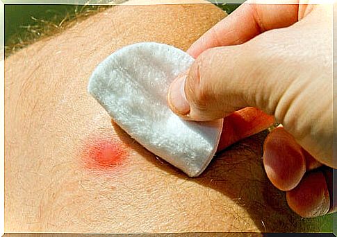 Natural signs and remedies for boils