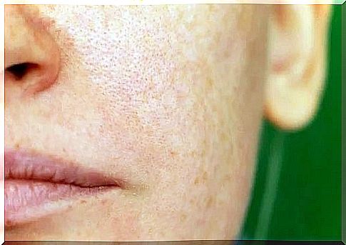 Natural remedies for melasma