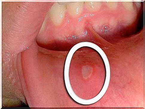 Canker sores can be a symptom of oropharyngeal cancer