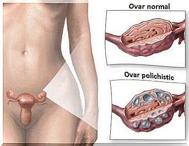 Polycystic ovary syndrome (PCOS).  Natural remedies