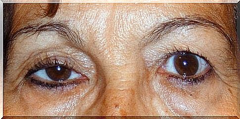 Remedies for droopy eyelids