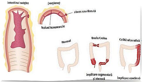 Ways to treat Crohn's disease that affects the intestines