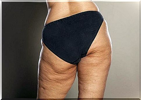 Woman in need of an anti-cellulite diet plan