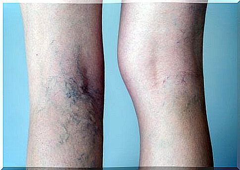 Varicose veins ointment with garlic and lemon