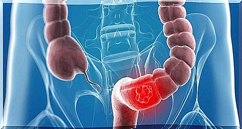 Drawing illustrating an intestinal blockage