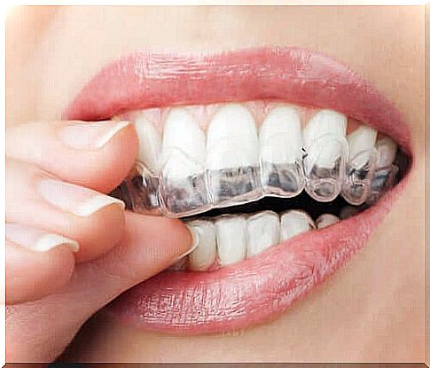 Invisible dental braces