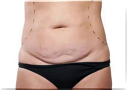 What is tummy tuck